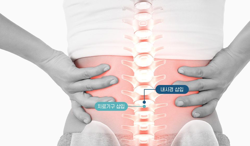 양방향 척추내시경
